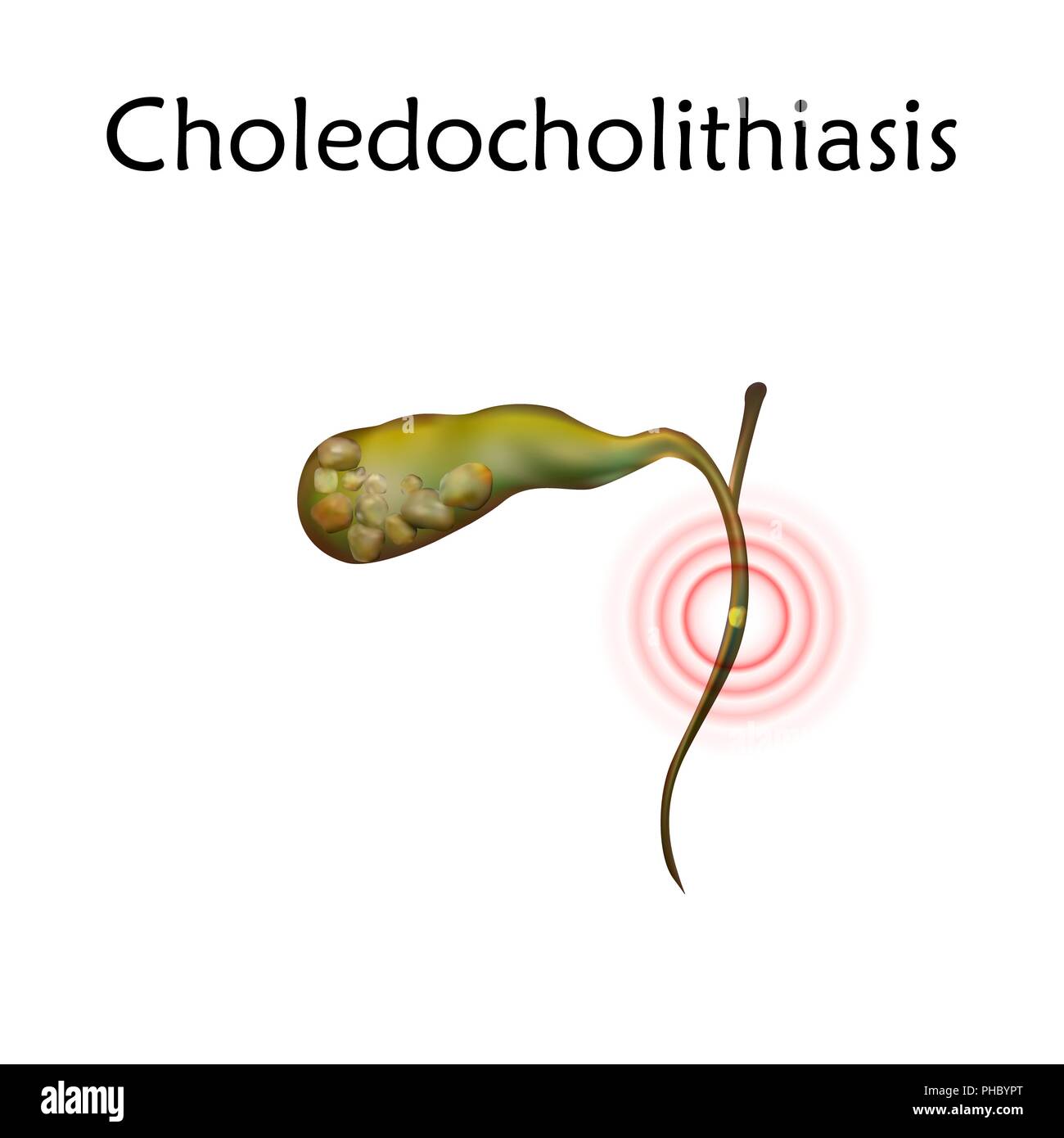 Choledocholithiasis, illustrazione. Questa è una condizione in cui una gallstone (o pietre) blocca il condotto biliare comune. Foto Stock