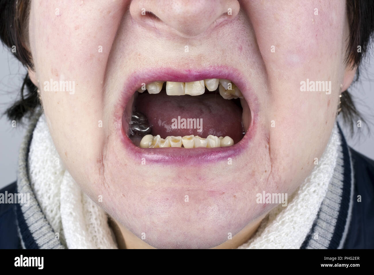 Distrutto womans denti Foto Stock