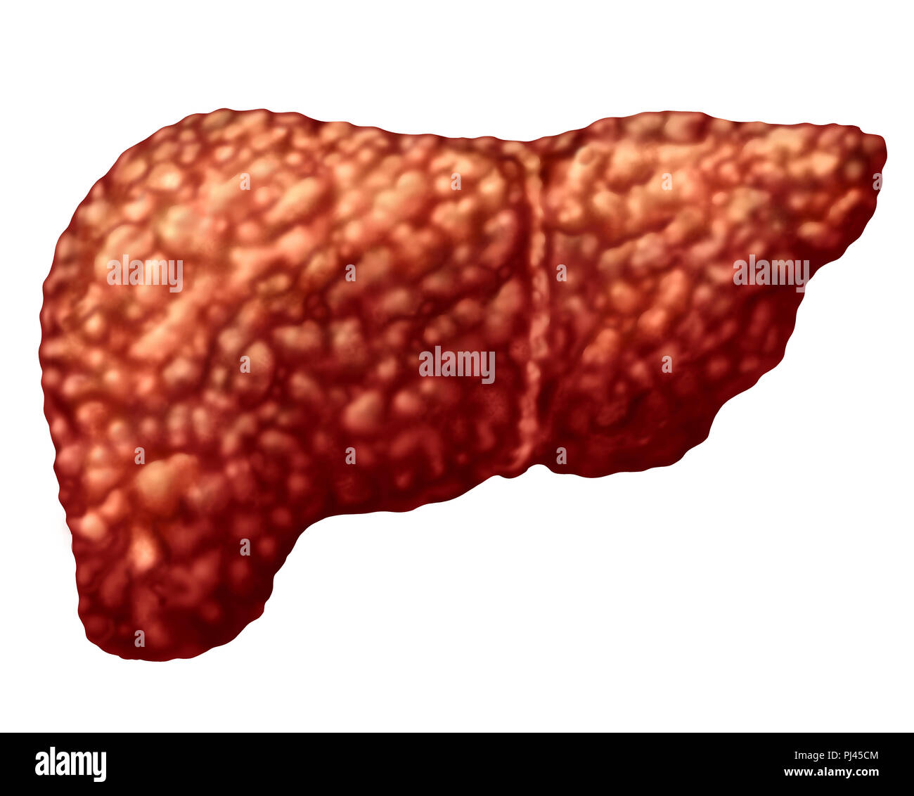 Fegato grasso e la steatosi epatica della parte di corpo isolato su bianco come un medico di cure sanitarie concetto del sistema digerente anatomia e organo vitale. Foto Stock