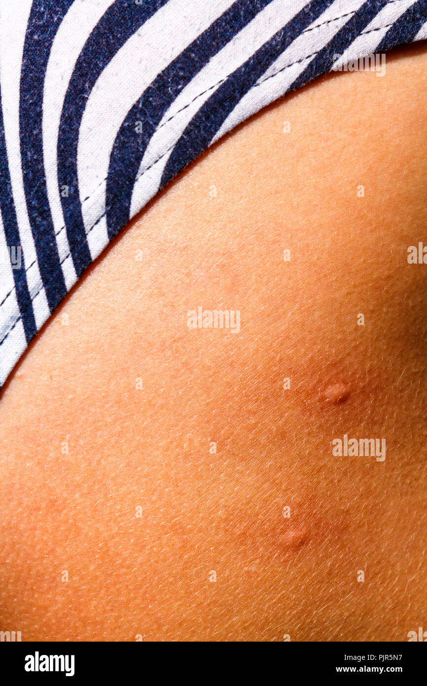 Sulla pelle bianca sono due gonfia le punture di zanzara Foto stock - Alamy