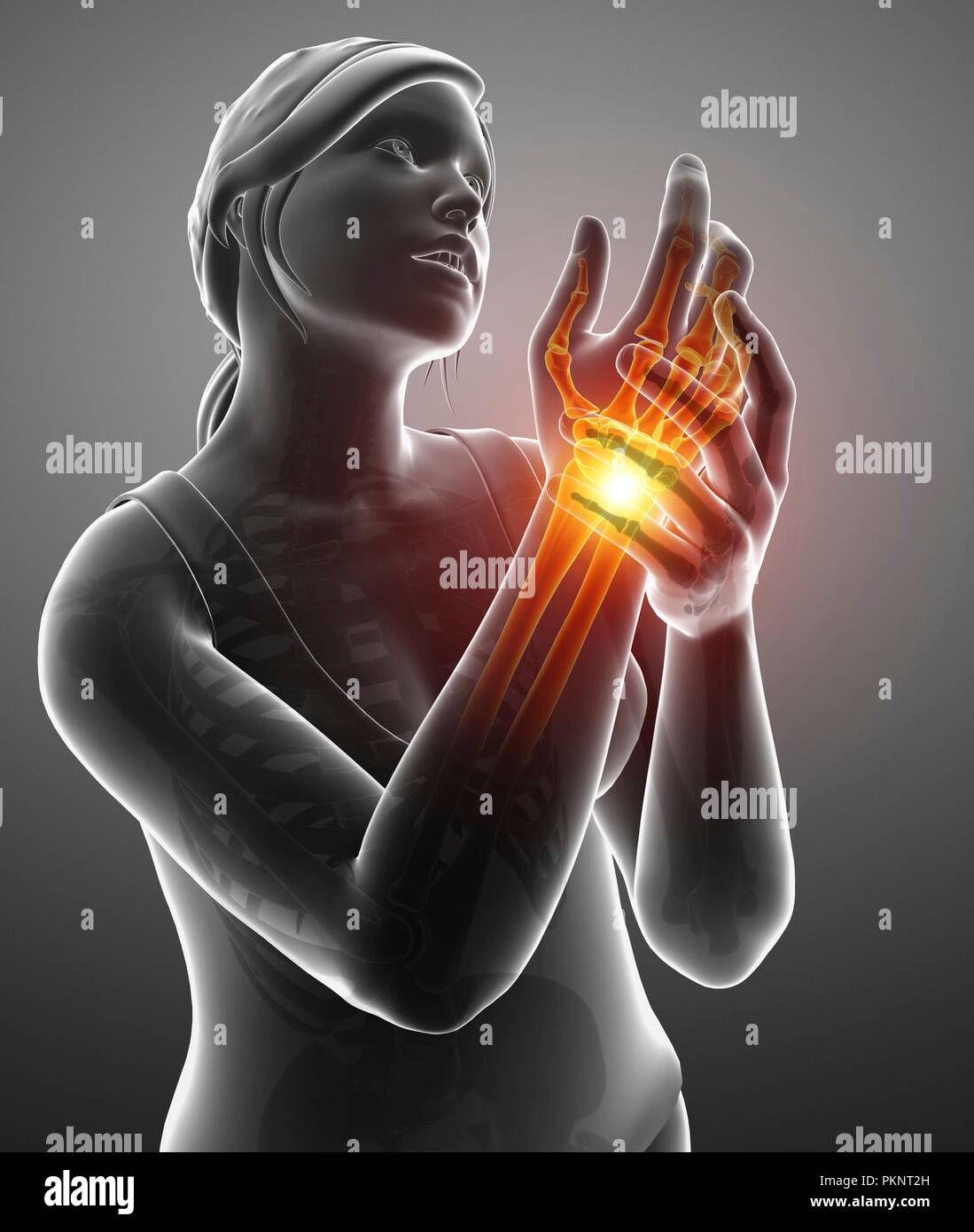Donna con dolore al polso, illustrazione del computer. Foto Stock