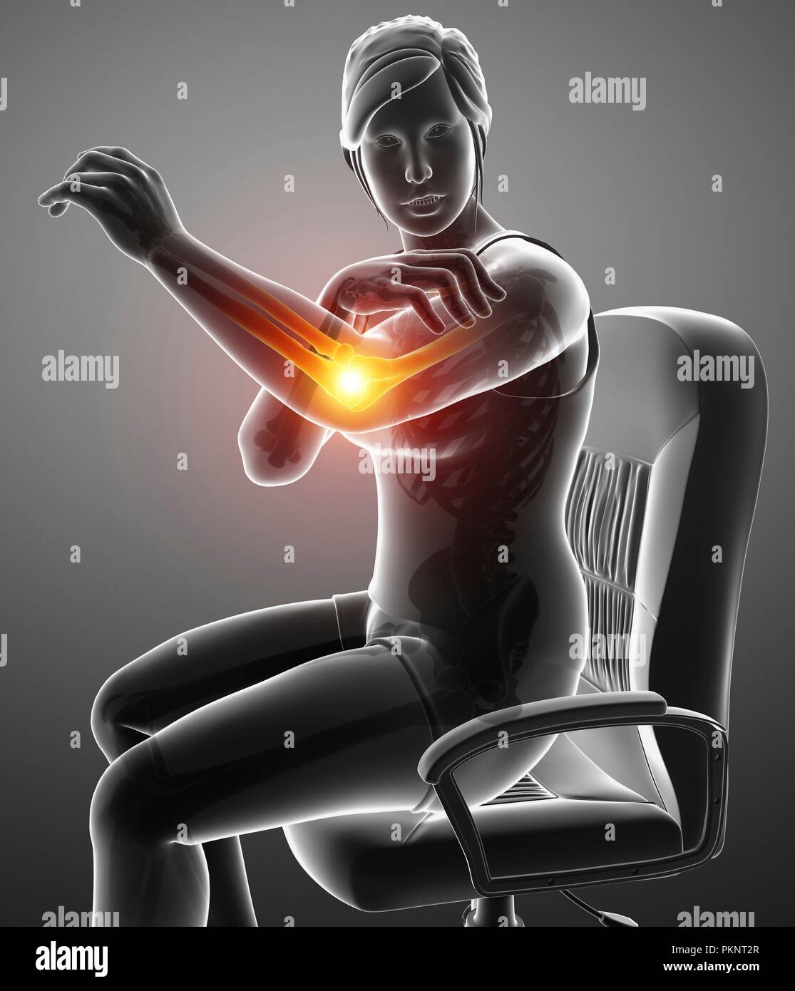 Donna con dolore a gomito, illustrazione del computer. Foto Stock