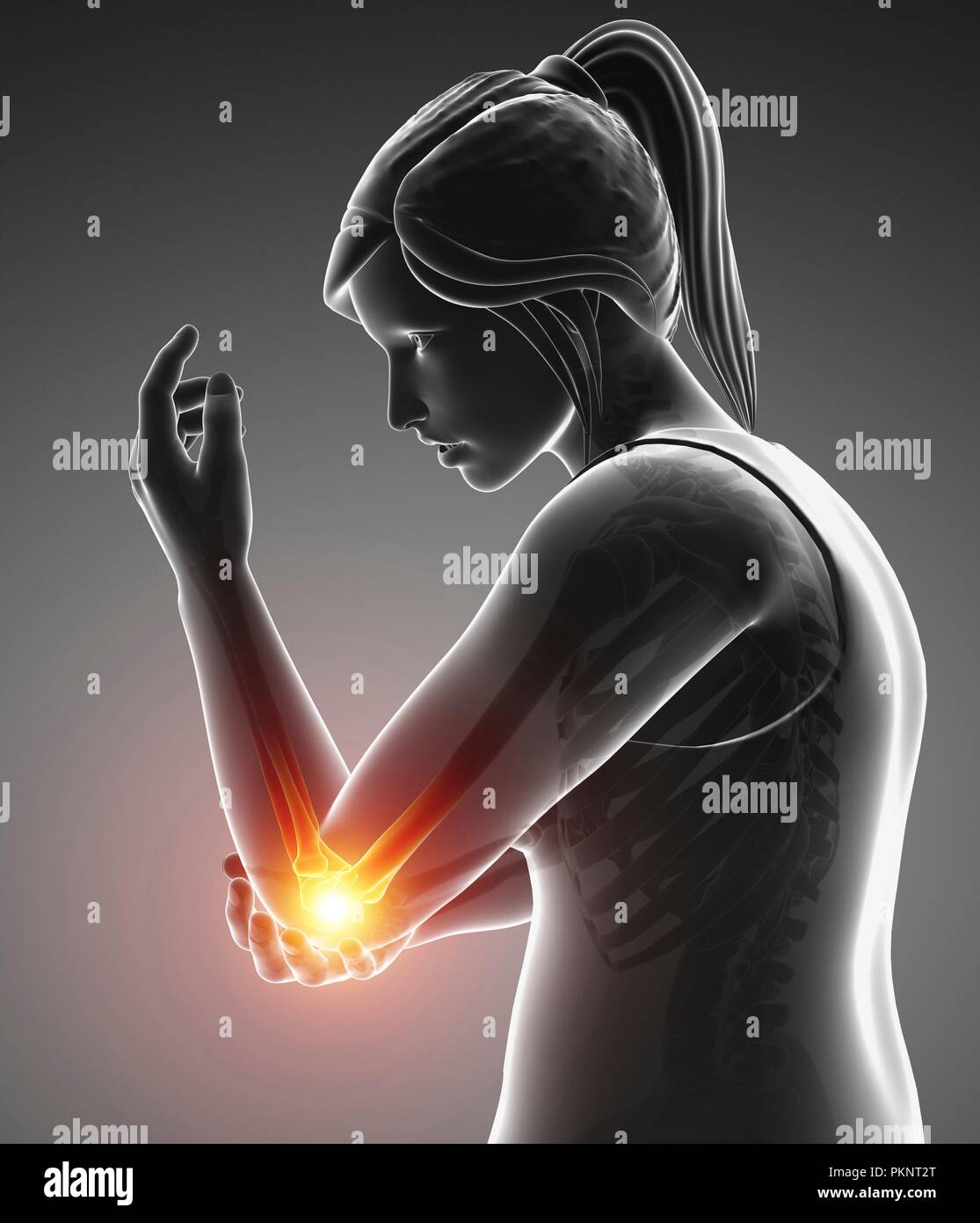 Donna con dolore a gomito, illustrazione del computer. Foto Stock
