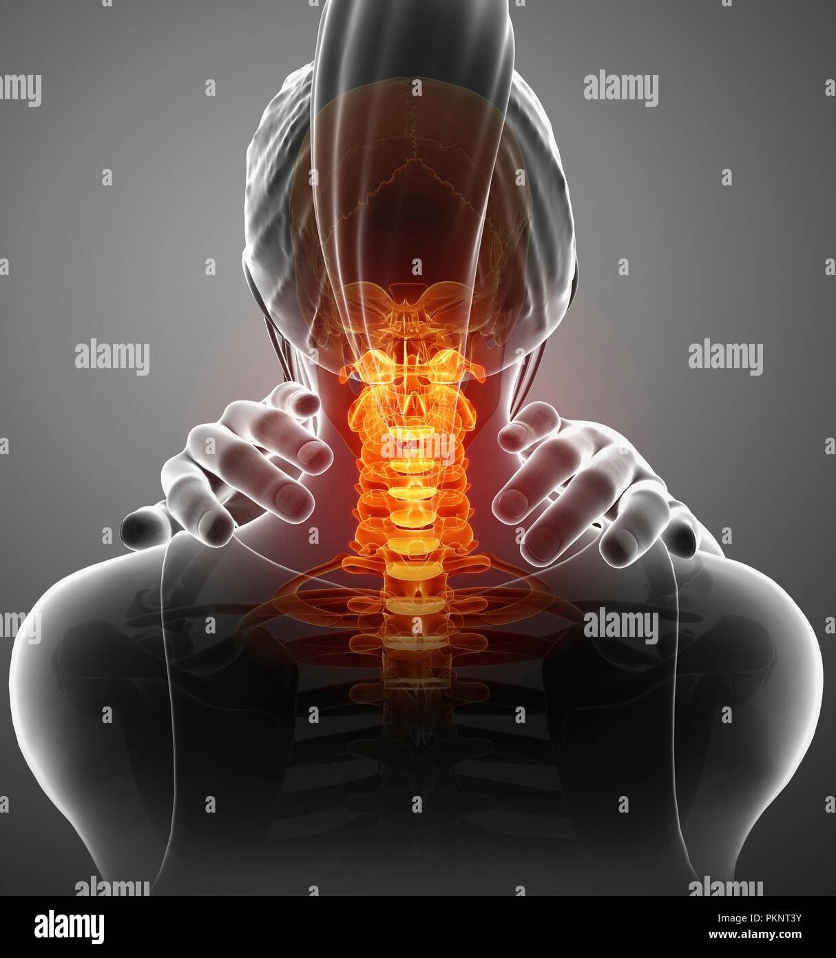 Donna con dolore al collo, illustrazione del computer. Foto Stock