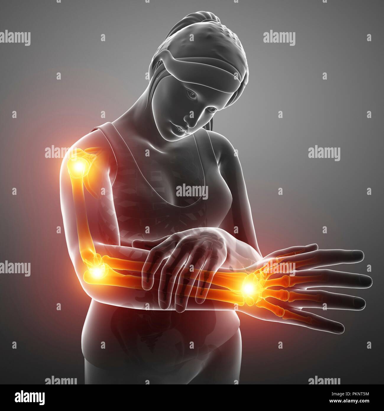 Donna con dolore al braccio, illustrazione del computer. Foto Stock