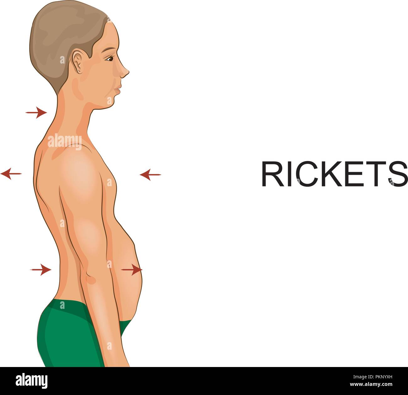 Illustrazione vettoriale di un ragazzo con segni di rachitismo Illustrazione Vettoriale