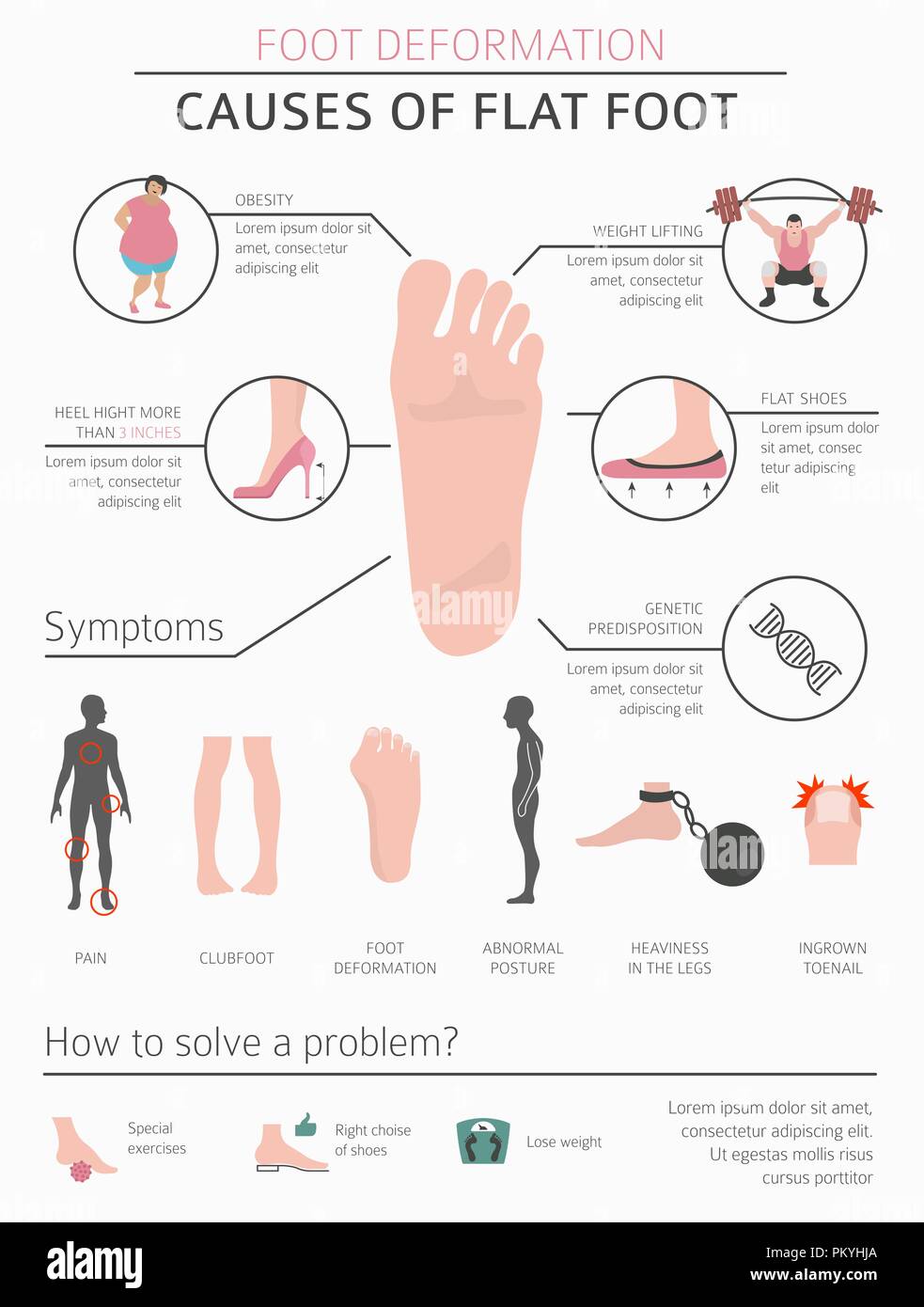 La deformazione del piede come malattia medica ed infografico. Cause di piede piatto. Illustrazione Vettoriale Illustrazione Vettoriale