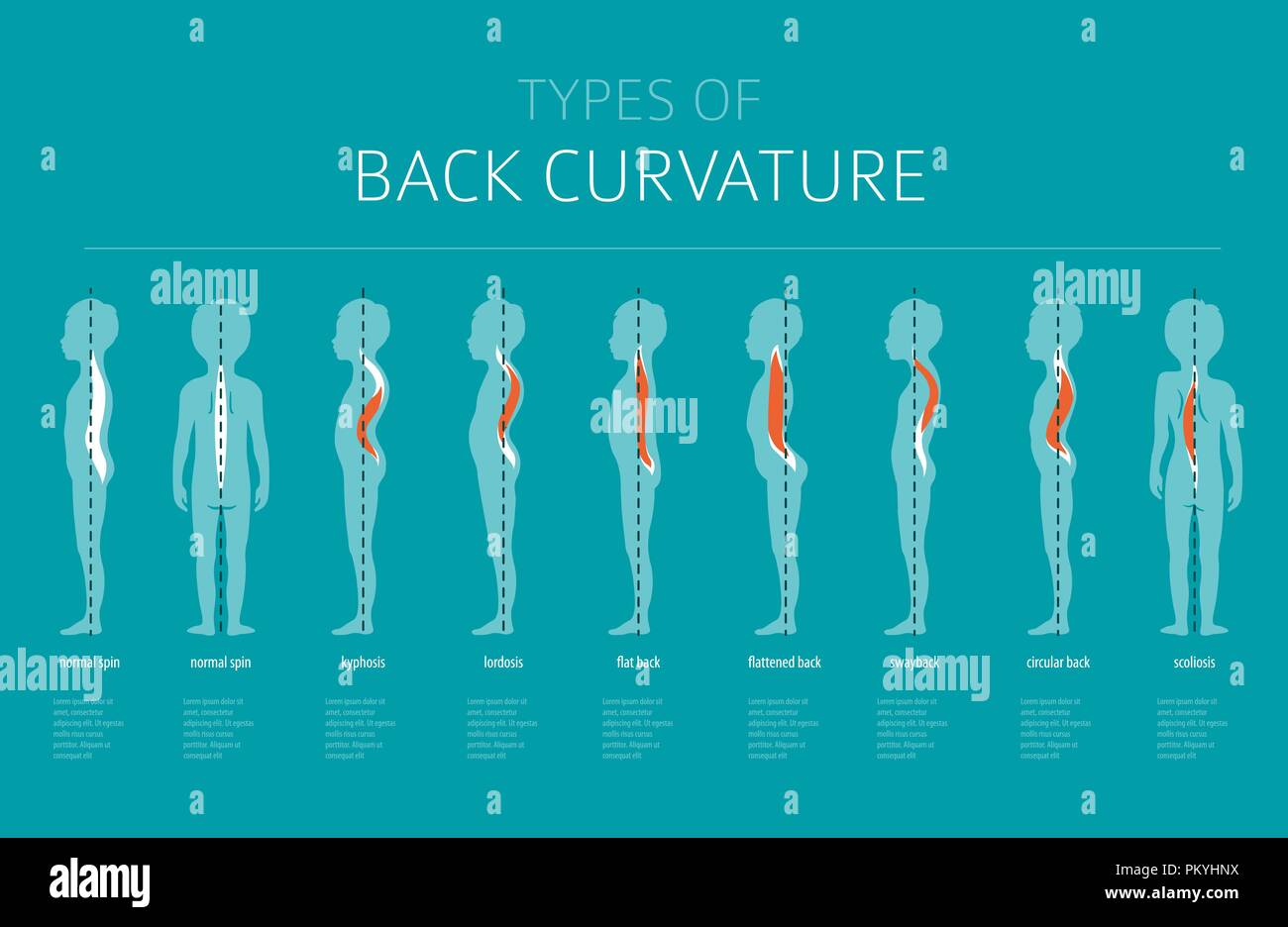 Tipi di curvatura posteriore. Patologia medica ed infografico. Illustrazione Vettoriale Illustrazione Vettoriale