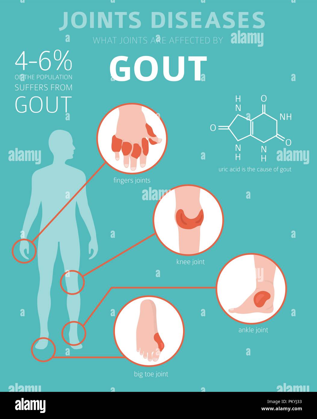 Giunti a malattie. Sintomi di gotta, trattamento icon set. Infografico medica design. Illustrazione Vettoriale Illustrazione Vettoriale