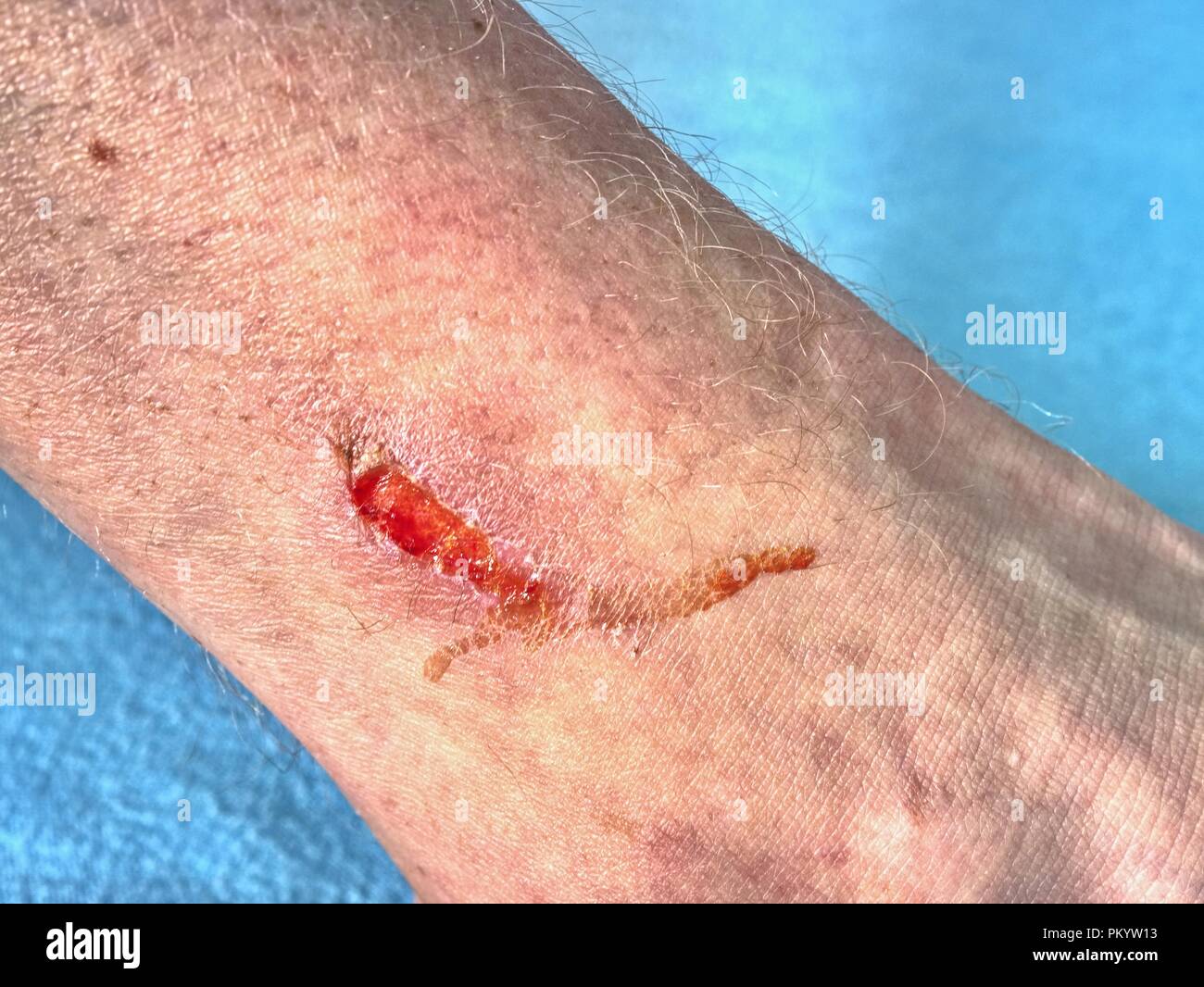 Ferita della pelle. Abrasione ad umido. Profonda ferita sulla pelle in  dettaglio Foto stock - Alamy