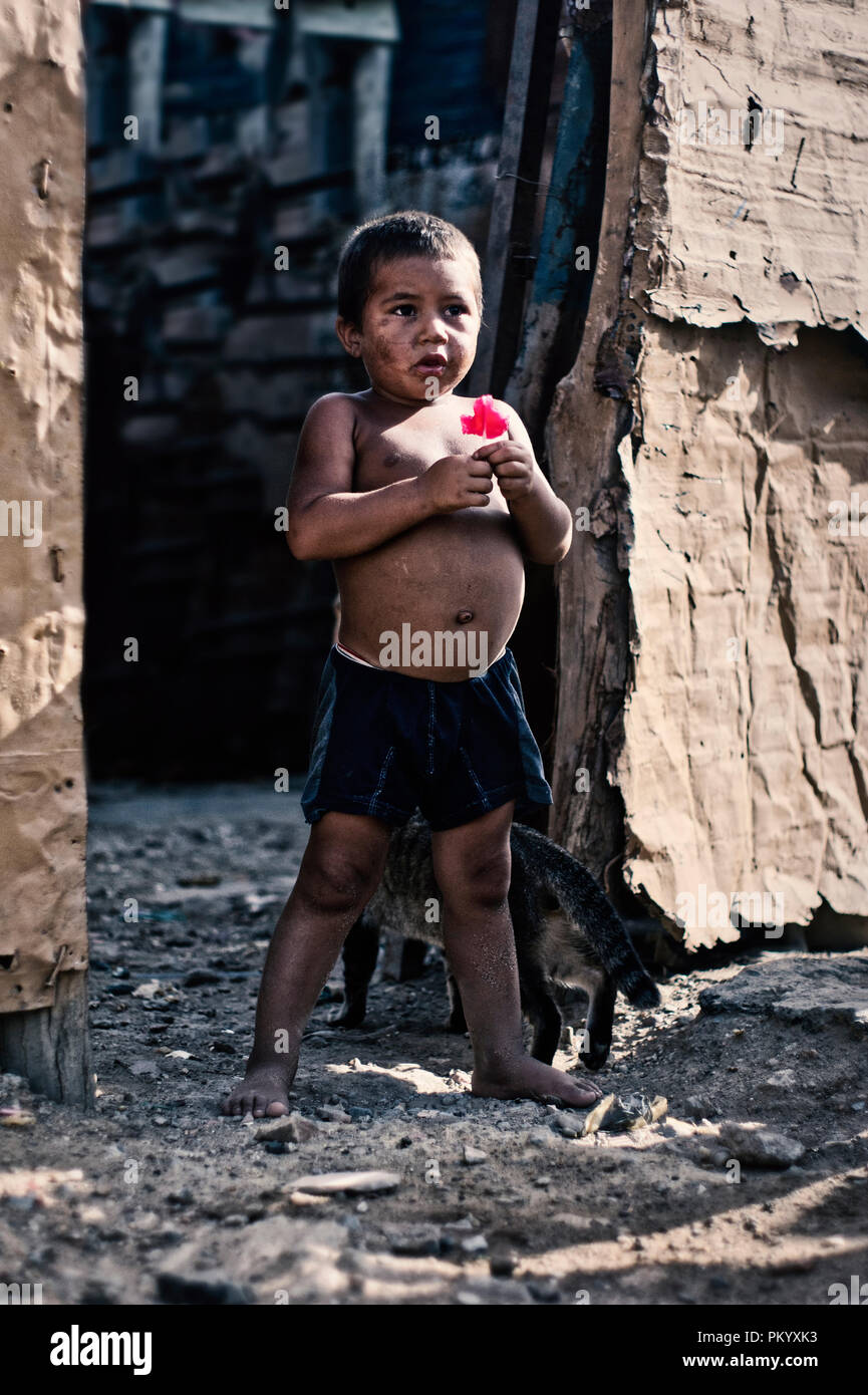 Barcellona, VENEZUELA 2 Giugno 2018: il bambino nella comunità povera 'ciudad de los mochos' con problemi di malnutrizione Kwashiorkor Foto Stock