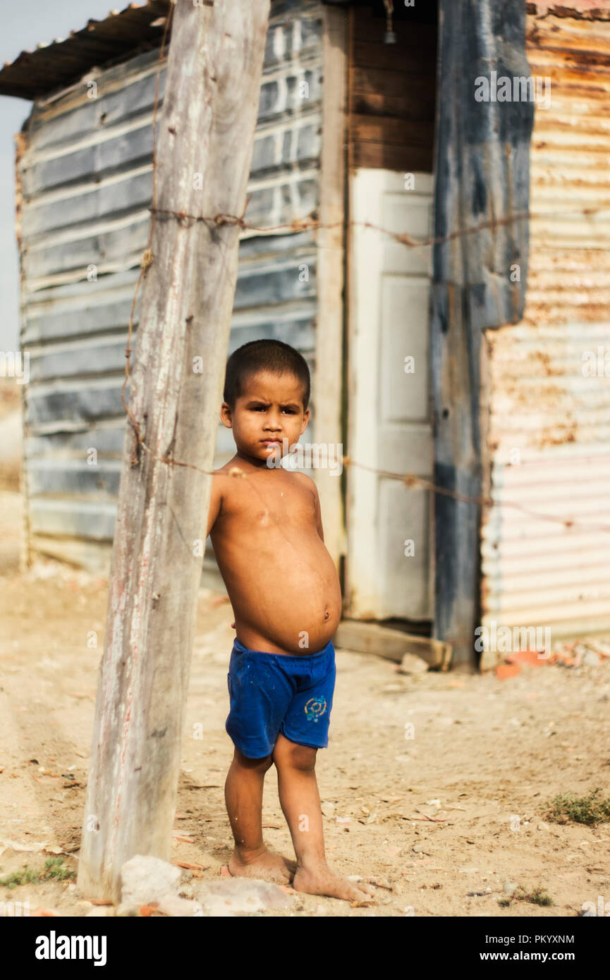 Barcellona, VENEZUELA 2 Giugno 2018: il bambino nella comunità povera 'ciudad de los mochos' con problemi di malnutrizione Kwashiorkor Foto Stock