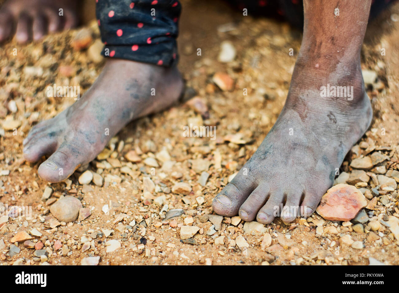 Barcellona, VENEZUELA Giugno 2, 2018: i piedi di una ragazza in una comunità povera 'ciudad de los mochos' Foto Stock