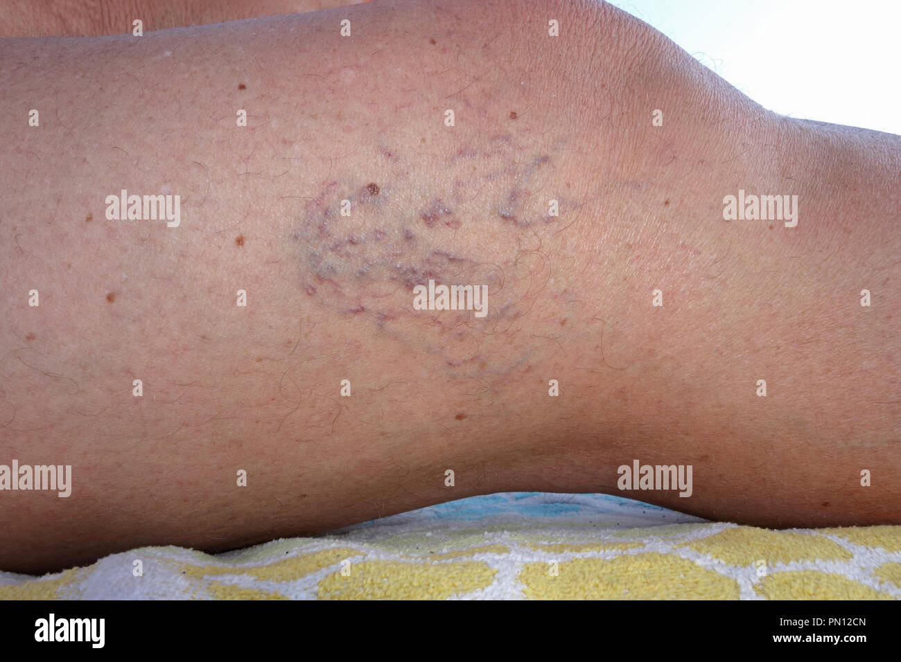 Femmina matura vene varicose gambe close up Foto Stock