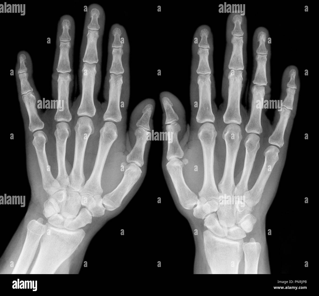 X-ray immagine medica - umani palms Foto Stock