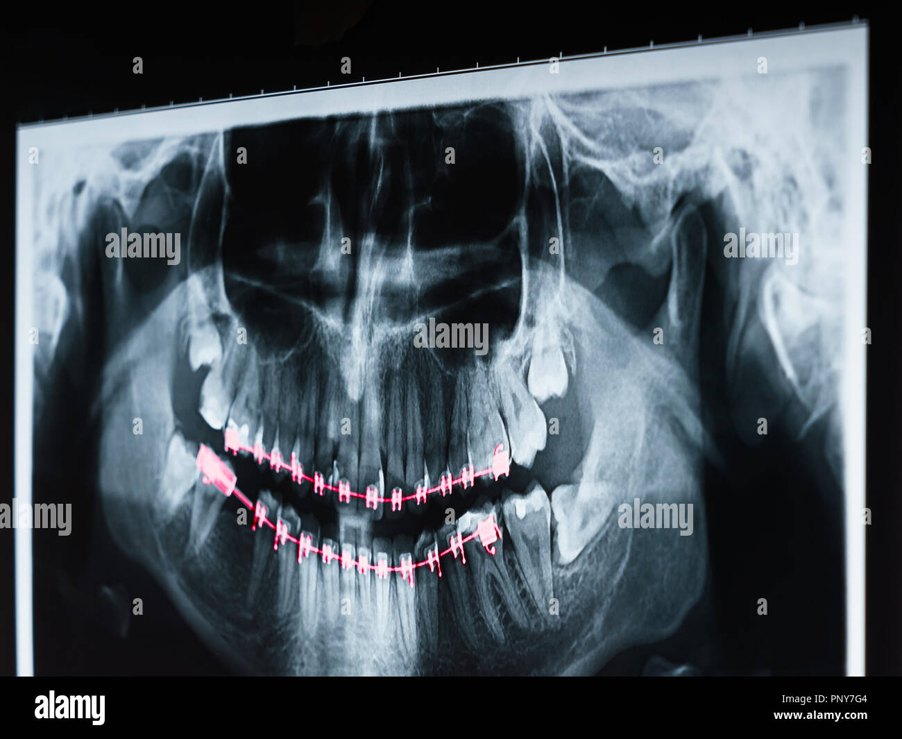 Apparecchiature odontoiatriche a raggi X e la foto del teschio umano e i denti con le bretelle Foto Stock