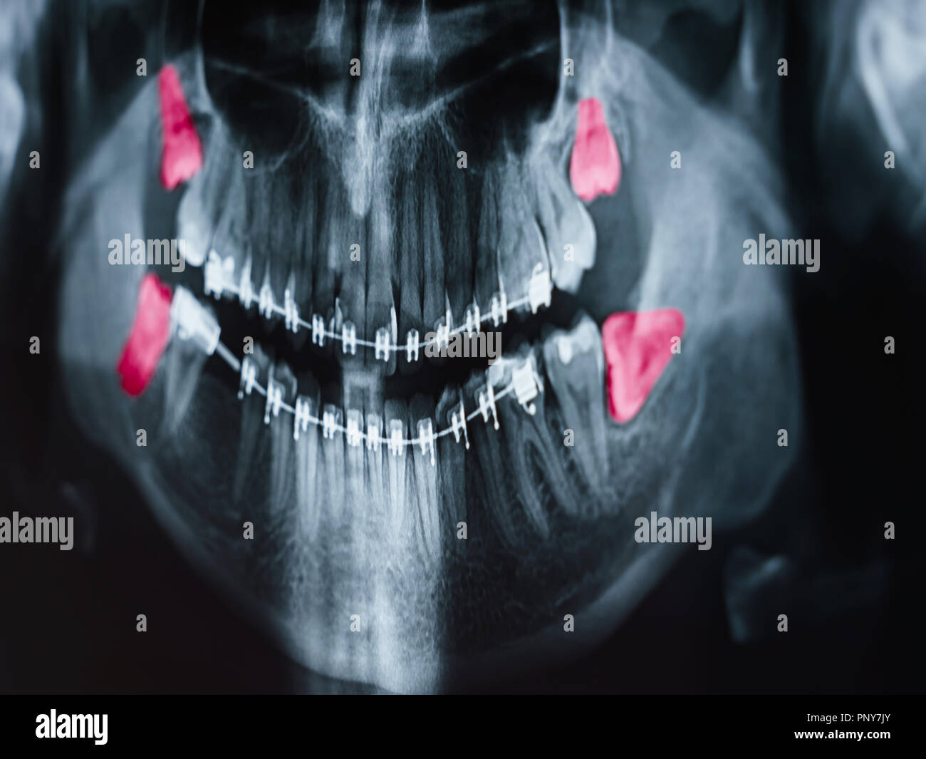 Crescente saggezza denti dolore a raggi X Foto Stock