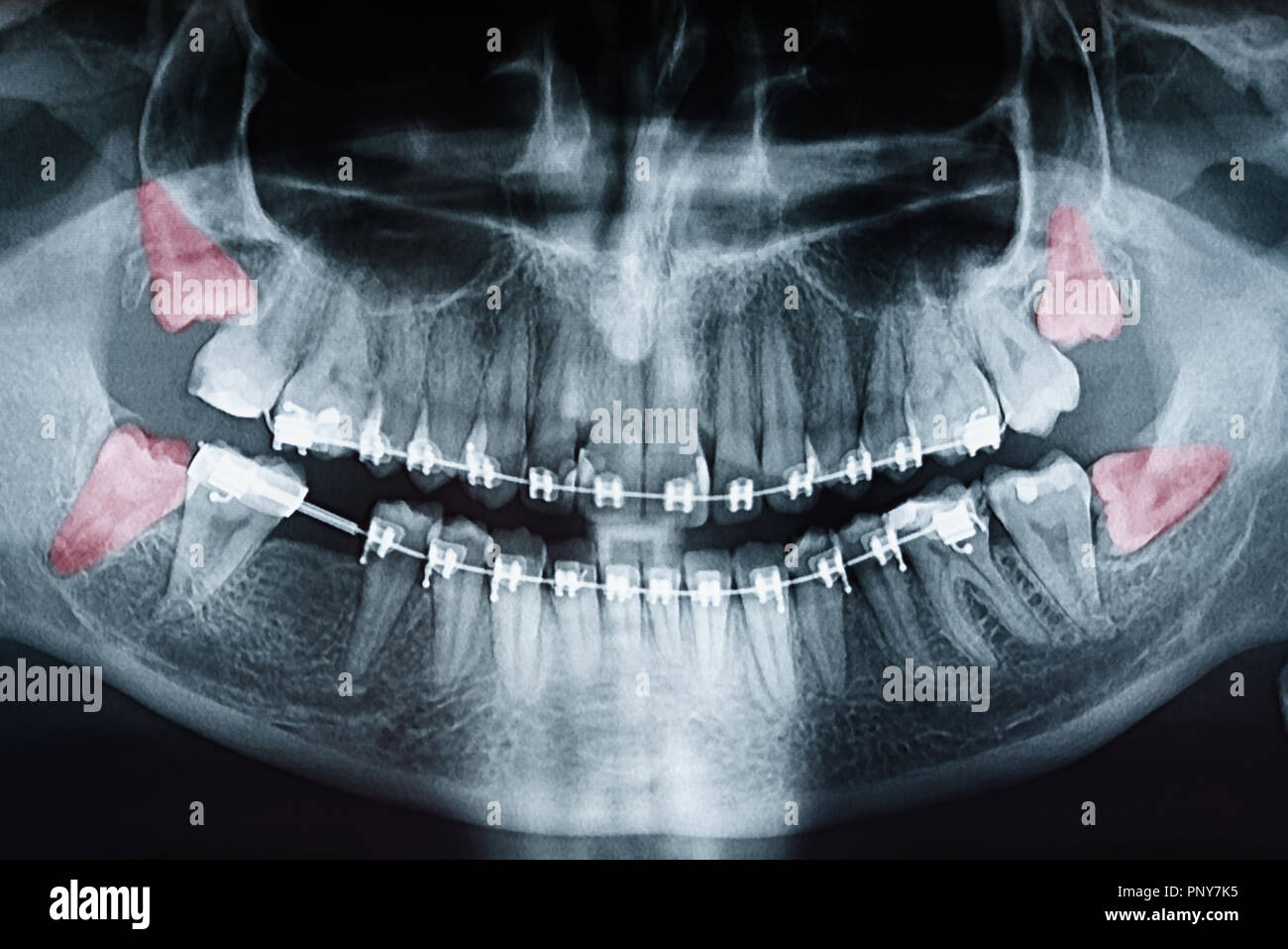 Crescente saggezza denti dolore a raggi X Foto Stock