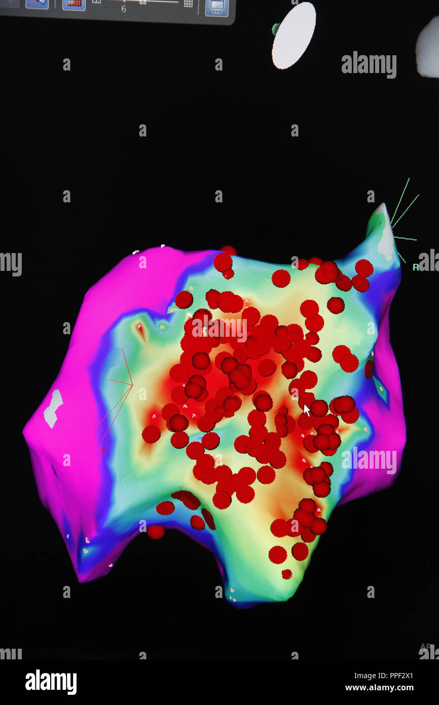 Immagine 3D del ventricolo sinistro al dolore toracico unità (CPU) dell Ospedale di Pasing Foto Stock
