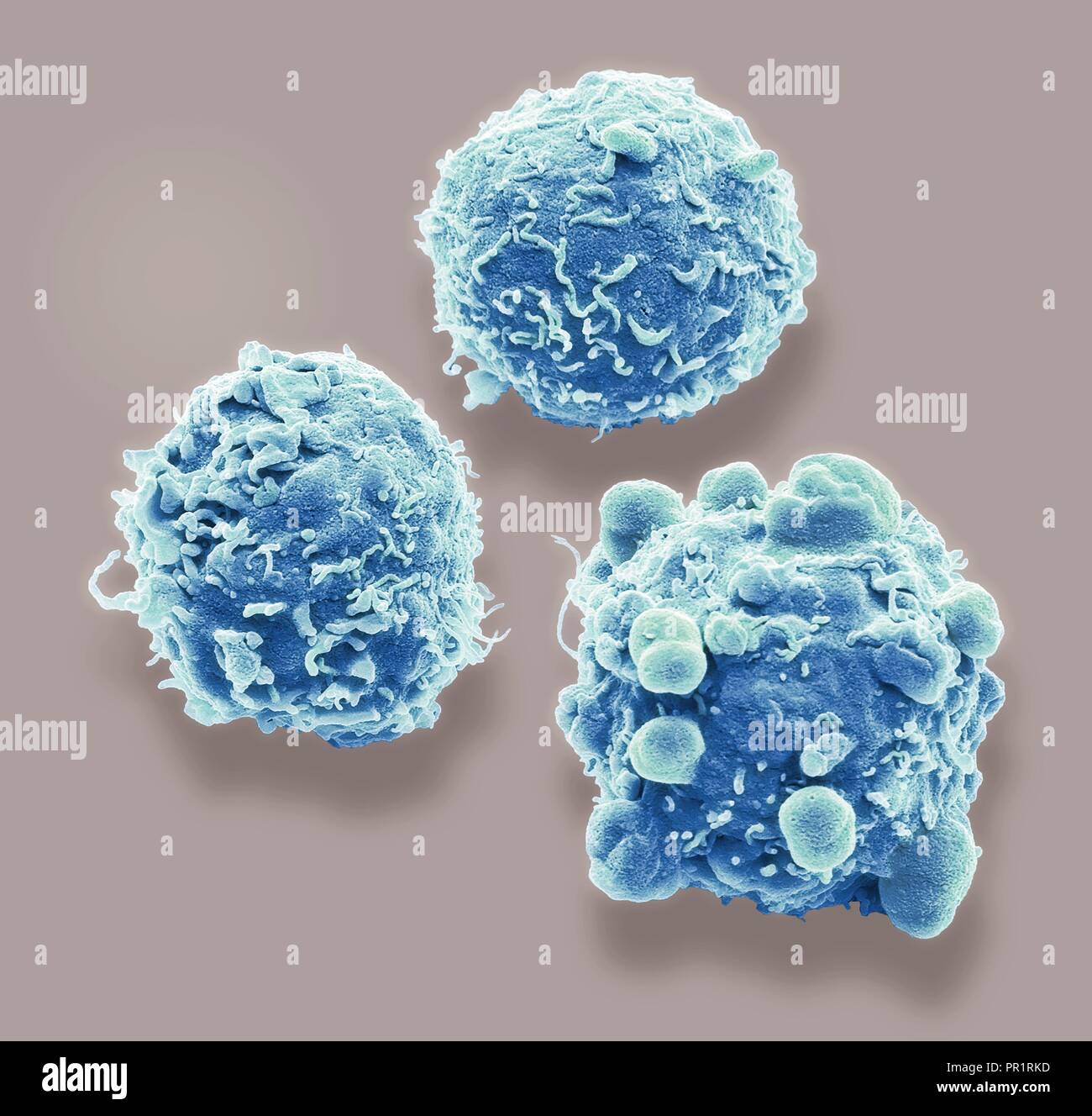 Cancro colorettale cellule. Color scanning electron microfotografia (SEM) delle cellule del cancro del colon umano (Intestino crasso). Il cancro del colon è anche noto come cancro del colon-retto. I sintomi includono emorragia rettale e dolore addominale. Il trattamento è con la chirurgia per rimuovere l'area interessata. Il cancro del colon è una delle più comuni forme di cancro in tutto il mondo occidentale. Ingrandimento: x 4000 quando stampato dieci centimetri di larghezza. Foto Stock