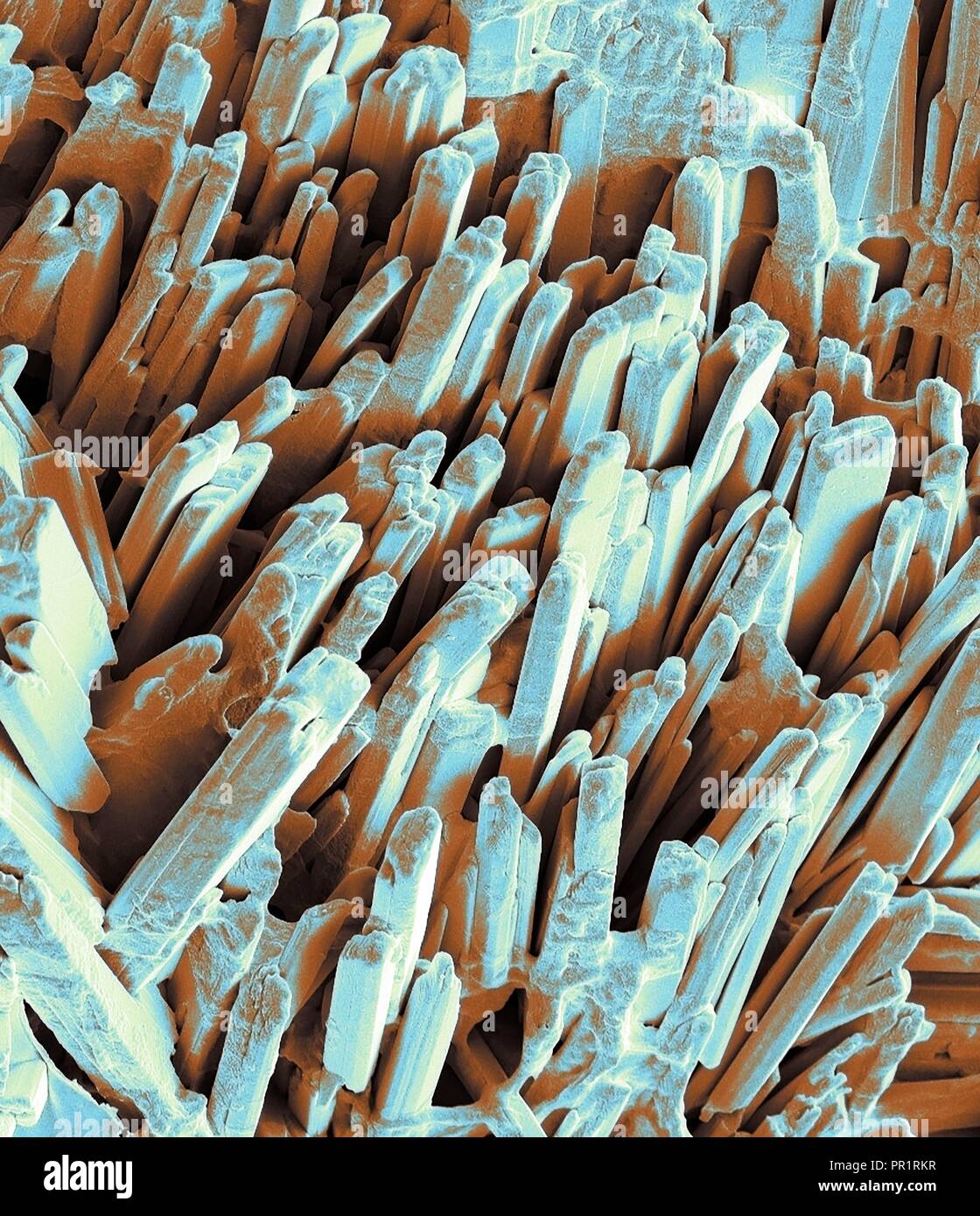 Gallstone cristalli. Color scanning electron microfotografia (SEM) della  superficie cristallina di un gallstone fratturato. Modulo di calcoli  biliari nella cistifellea quando vi è uno squilibrio nella composizione  chimica della bile. Calcoli biliari