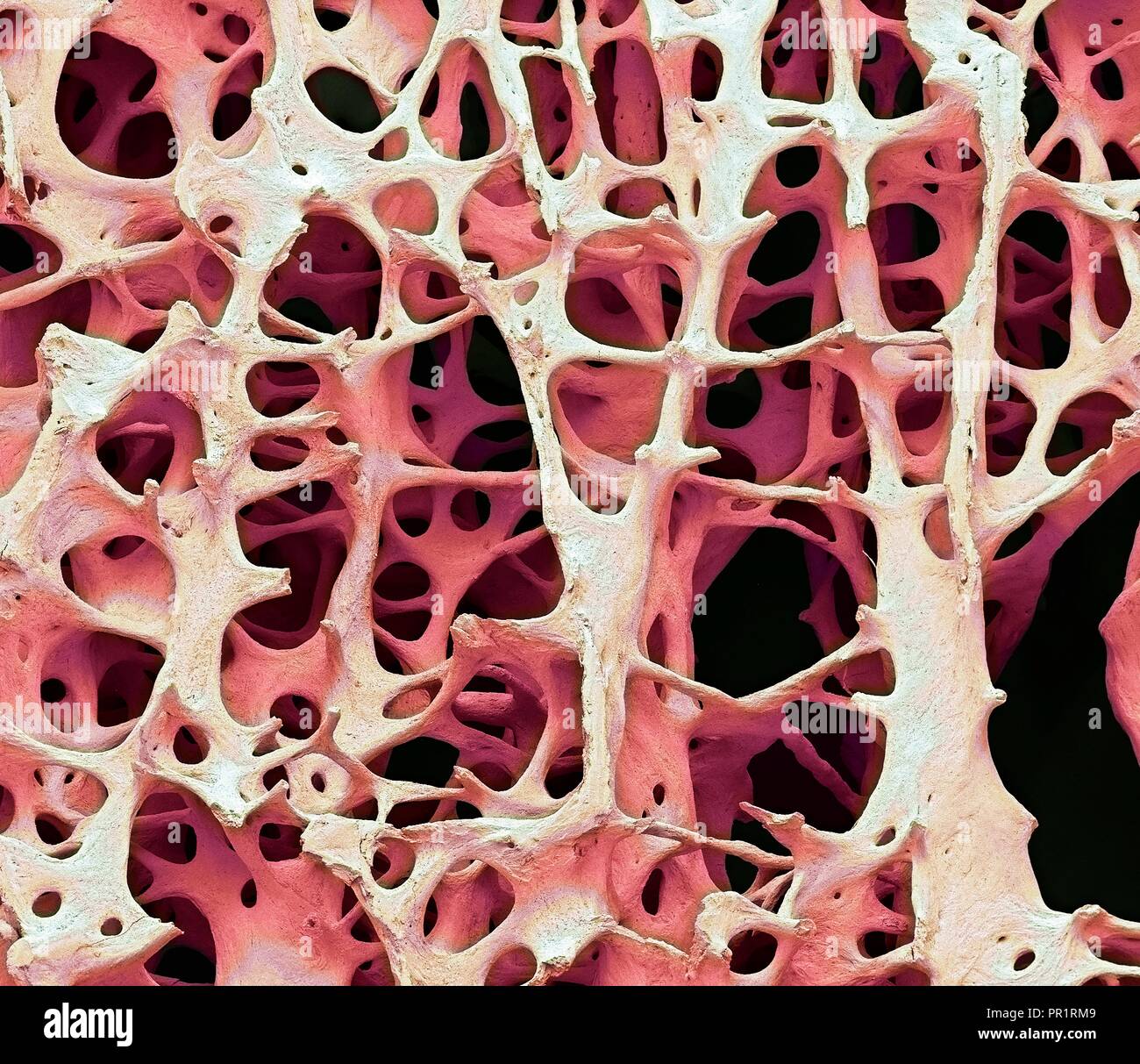 Il tessuto osseo. Color scanning electron microfotografia (SEM) di spugnoso umano (spugnosa ossea). Il tessuto osseo può essere sia (corticale compatta) spugnoso o. L'osso corticale di solito rende l'esterno dell'osso, mentre l'osso spugnoso si trova all'interno. Osso spongioso è caratterizzato da una disposizione a nido d'ape, comprendente una rete di trabecole (a forma di asta di tessuto). Queste strutture forniscono sostegno e forza per l'osso. Gli spazi all'interno di questo tessuto contengono midollo osseo (non visibile), un sangue di sostanza di formazione. Ingrandimento: x13 quando stampata 10cm di larghezza. Foto Stock