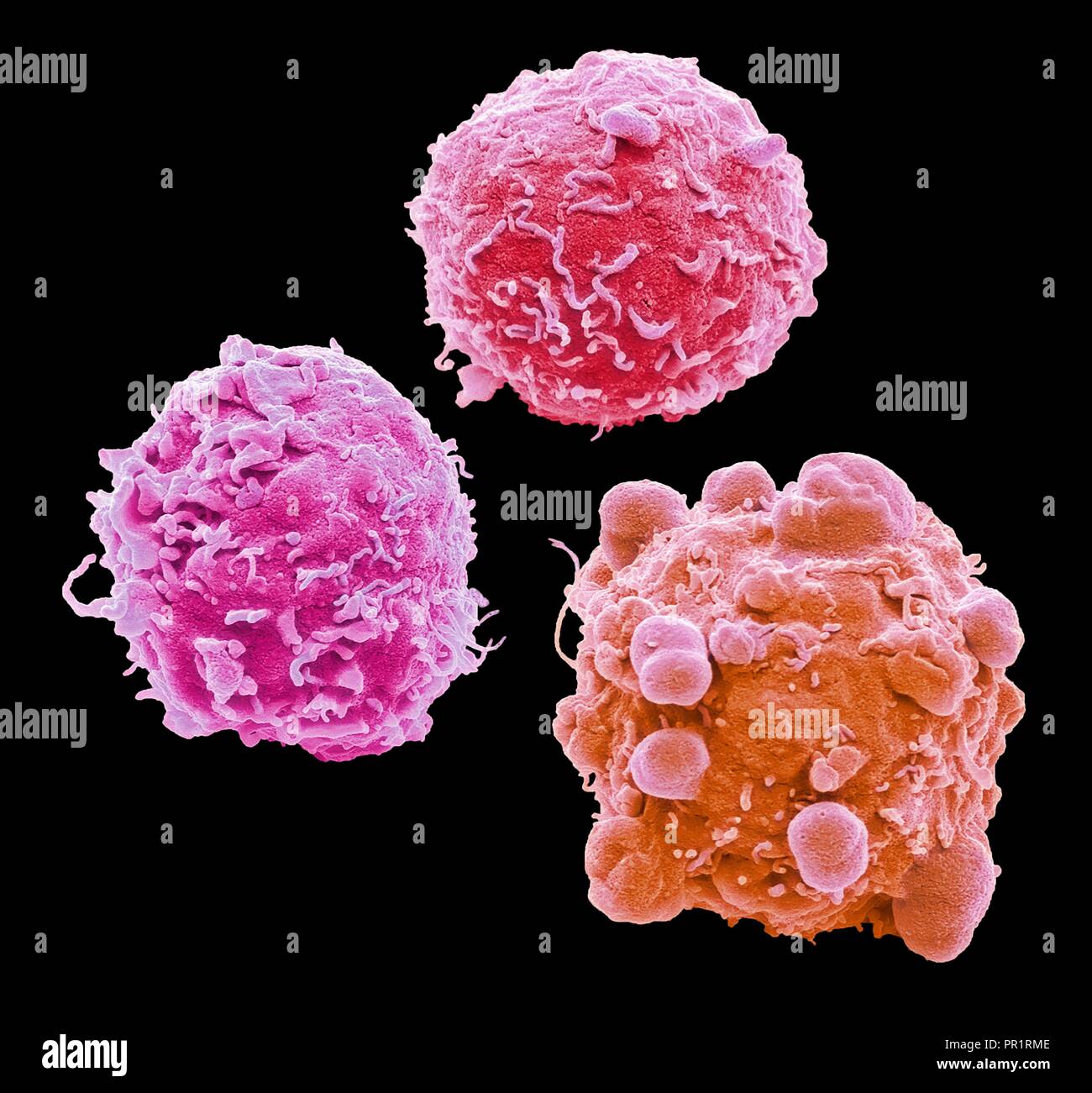 Cancro colorettale cellule. Color scanning electron microfotografia (SEM) delle cellule del cancro del colon umano (Intestino crasso). Il cancro del colon è anche noto come cancro del colon-retto. I sintomi includono emorragia rettale e dolore addominale. Il trattamento è con la chirurgia per rimuovere l'area interessata. Il cancro del colon è una delle più comuni forme di cancro in tutto il mondo occidentale. Ingrandimento: x 4000 quando stampato dieci centimetri di larghezza. Foto Stock