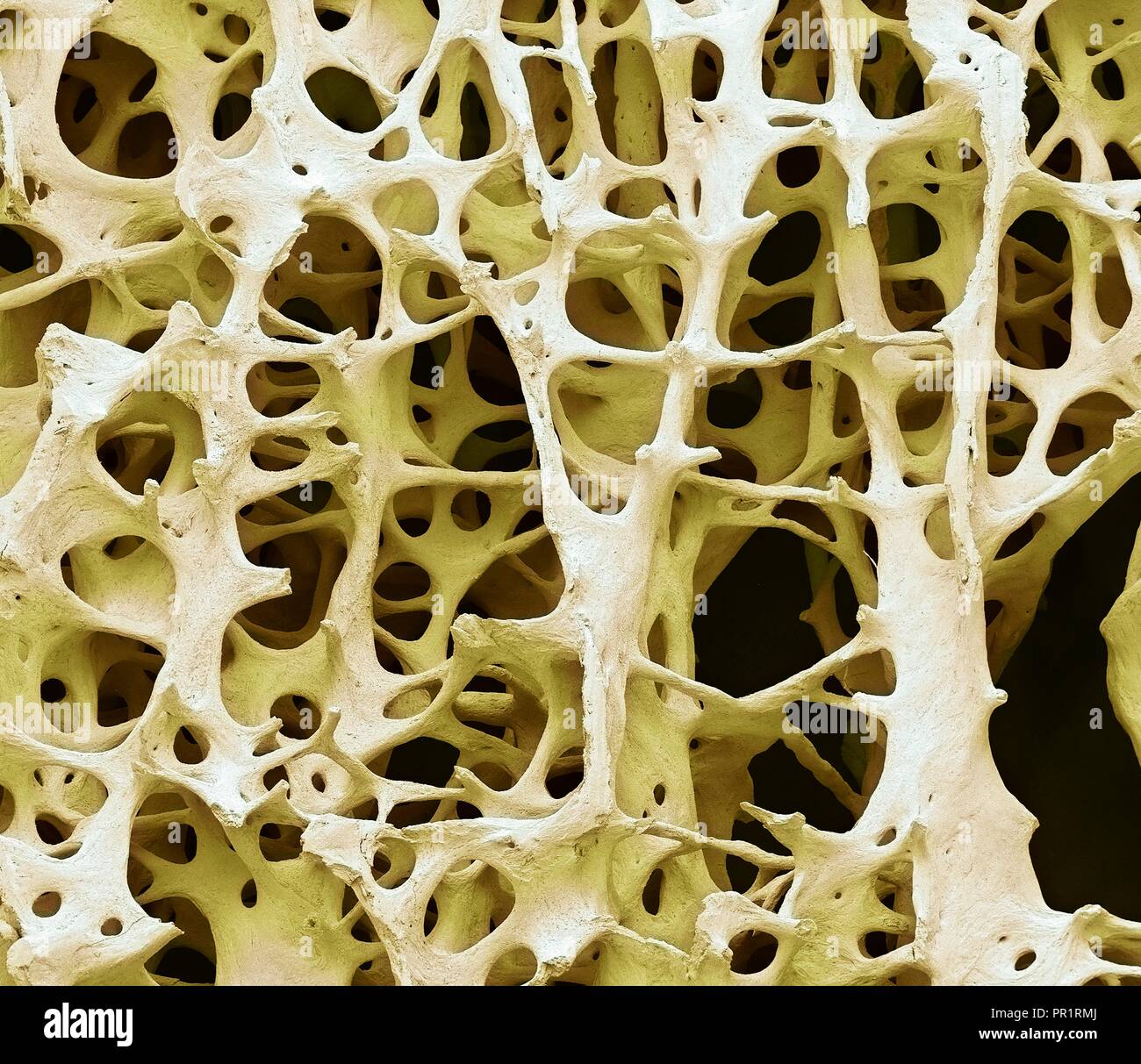 Il tessuto osseo. Color scanning electron microfotografia (SEM) di spugnoso umano (spugnosa ossea). Il tessuto osseo può essere sia (corticale compatta) spugnoso o. L'osso corticale di solito rende l'esterno dell'osso, mentre l'osso spugnoso si trova all'interno. Osso spongioso è caratterizzato da una disposizione a nido d'ape, comprendente una rete di trabecole (a forma di asta di tessuto). Queste strutture forniscono sostegno e forza per l'osso. Gli spazi all'interno di questo tessuto contengono midollo osseo (non visibile), un sangue di sostanza di formazione. Ingrandimento: x13 quando stampata 10cm di larghezza. Foto Stock
