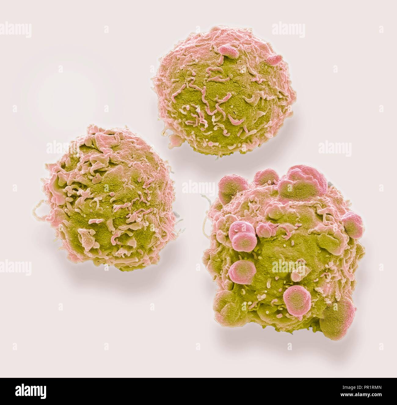Cancro colorettale cellule. Color scanning electron microfotografia (SEM) delle cellule del cancro del colon umano (Intestino crasso). Il cancro del colon è anche noto come cancro del colon-retto. I sintomi includono emorragia rettale e dolore addominale. Il trattamento è con la chirurgia per rimuovere l'area interessata. Il cancro del colon è una delle più comuni forme di cancro in tutto il mondo occidentale. Ingrandimento: x4, 000 quando vengono stampate 10 centimetri di larghezza. Foto Stock