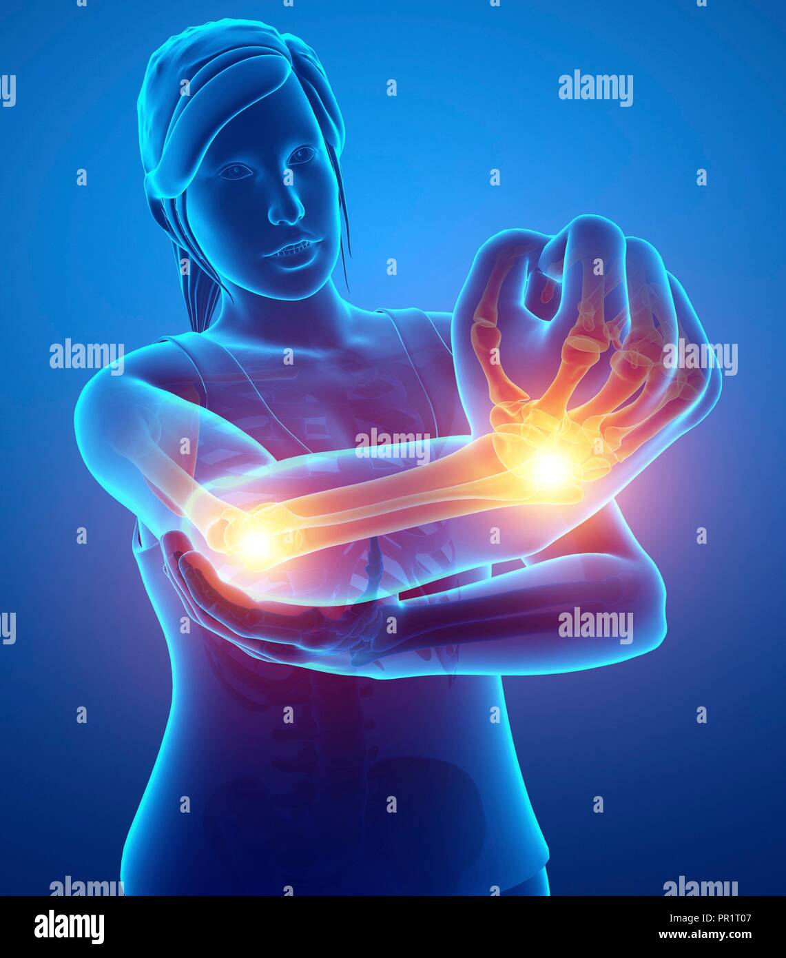 Donna con dolore al braccio, illustrazione del computer. Foto Stock