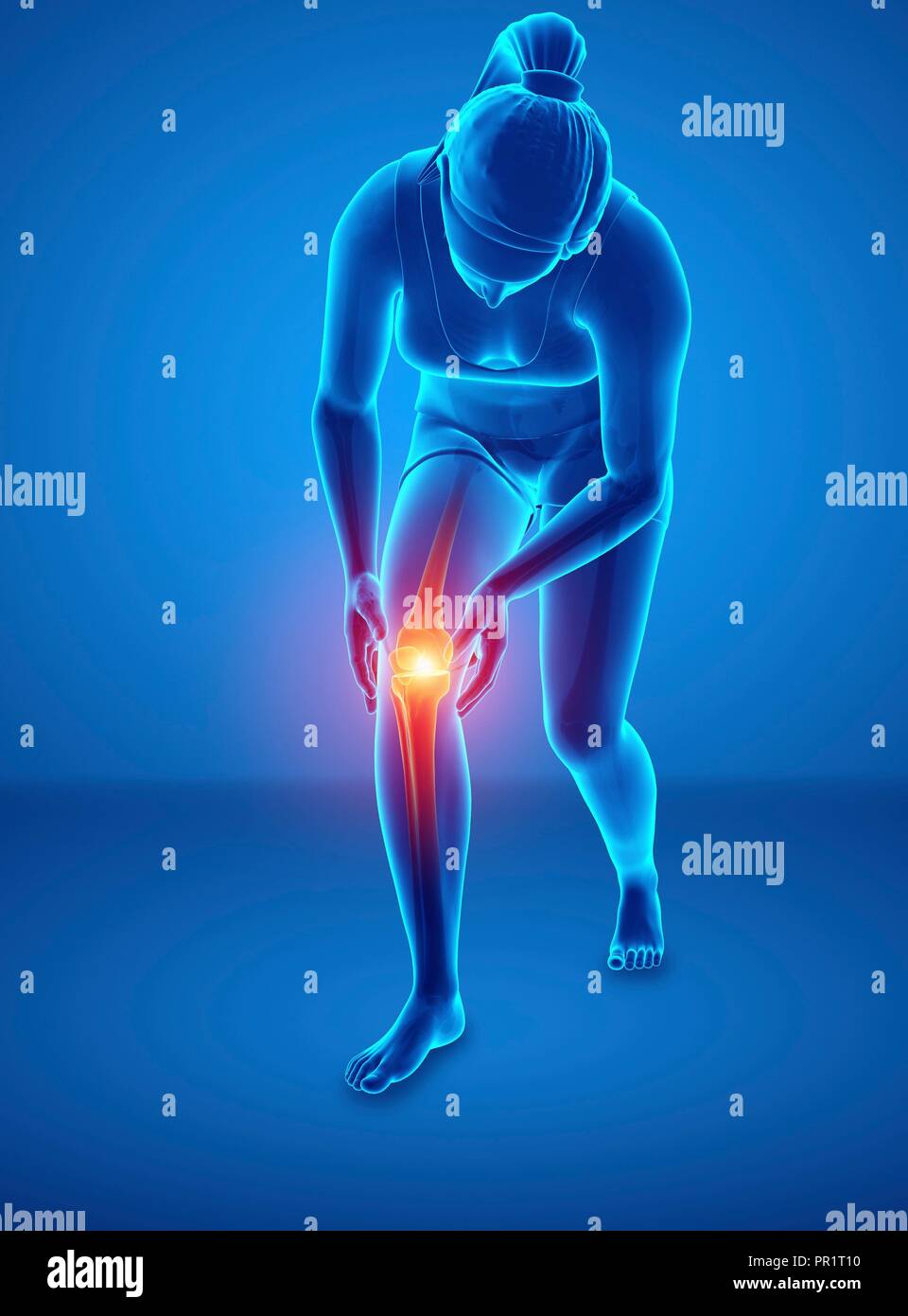Donna con il dolore al ginocchio, illustrazione del computer. Foto Stock