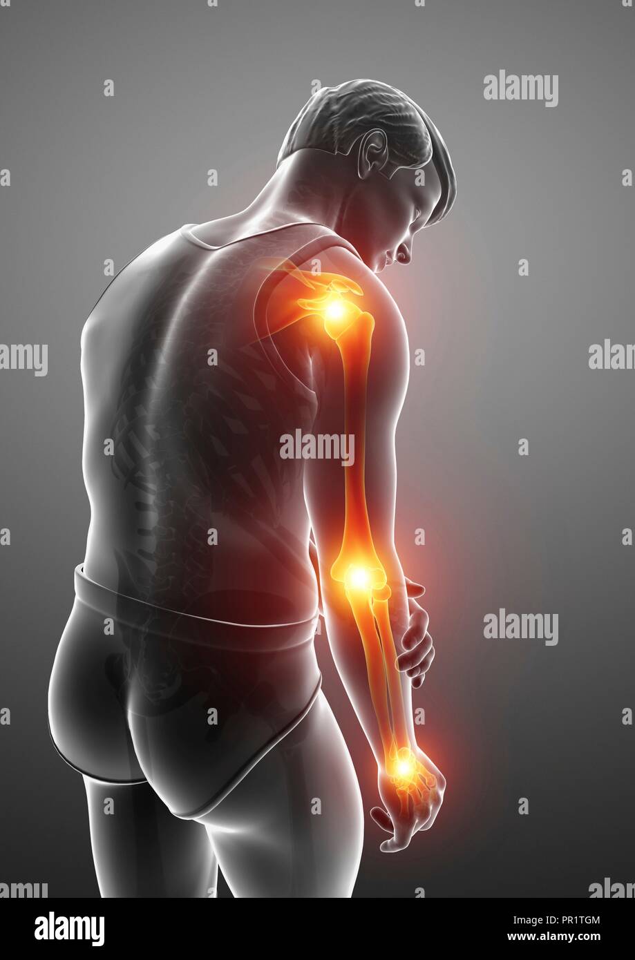 Uomo con dolore al braccio, illustrazione del computer. Foto Stock