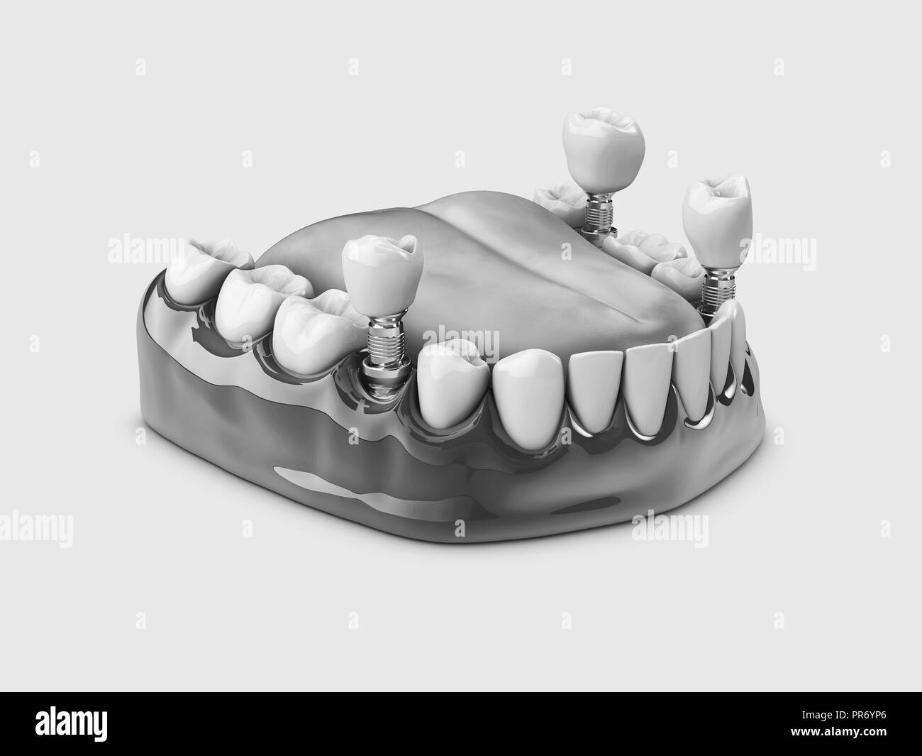 Denti umani e impianto dentale. in bianco e nero 3d'illustrazione. Foto Stock