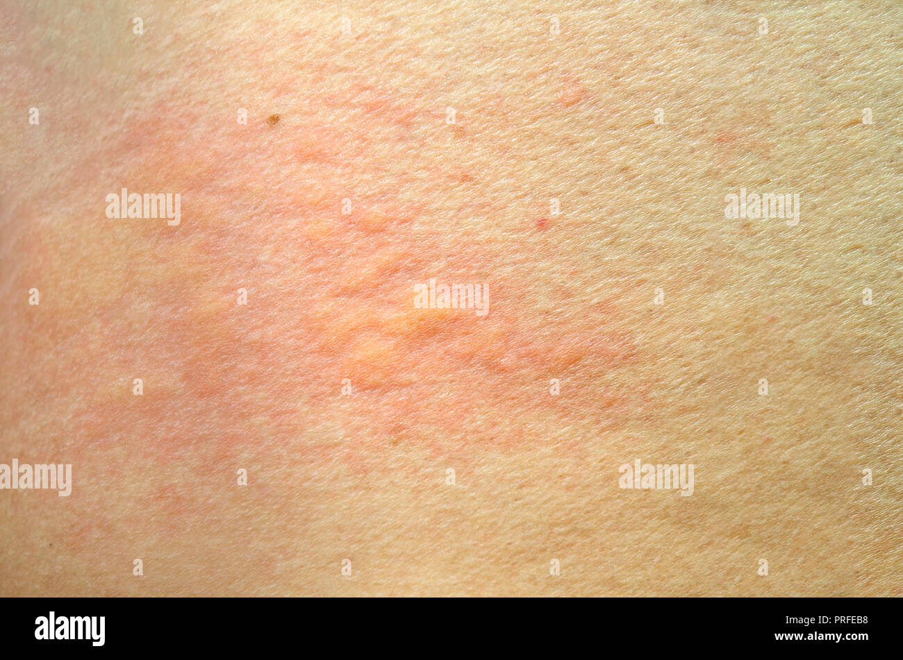 Reazione Allergica Cutanea Immagini e Fotos Stock Alamy