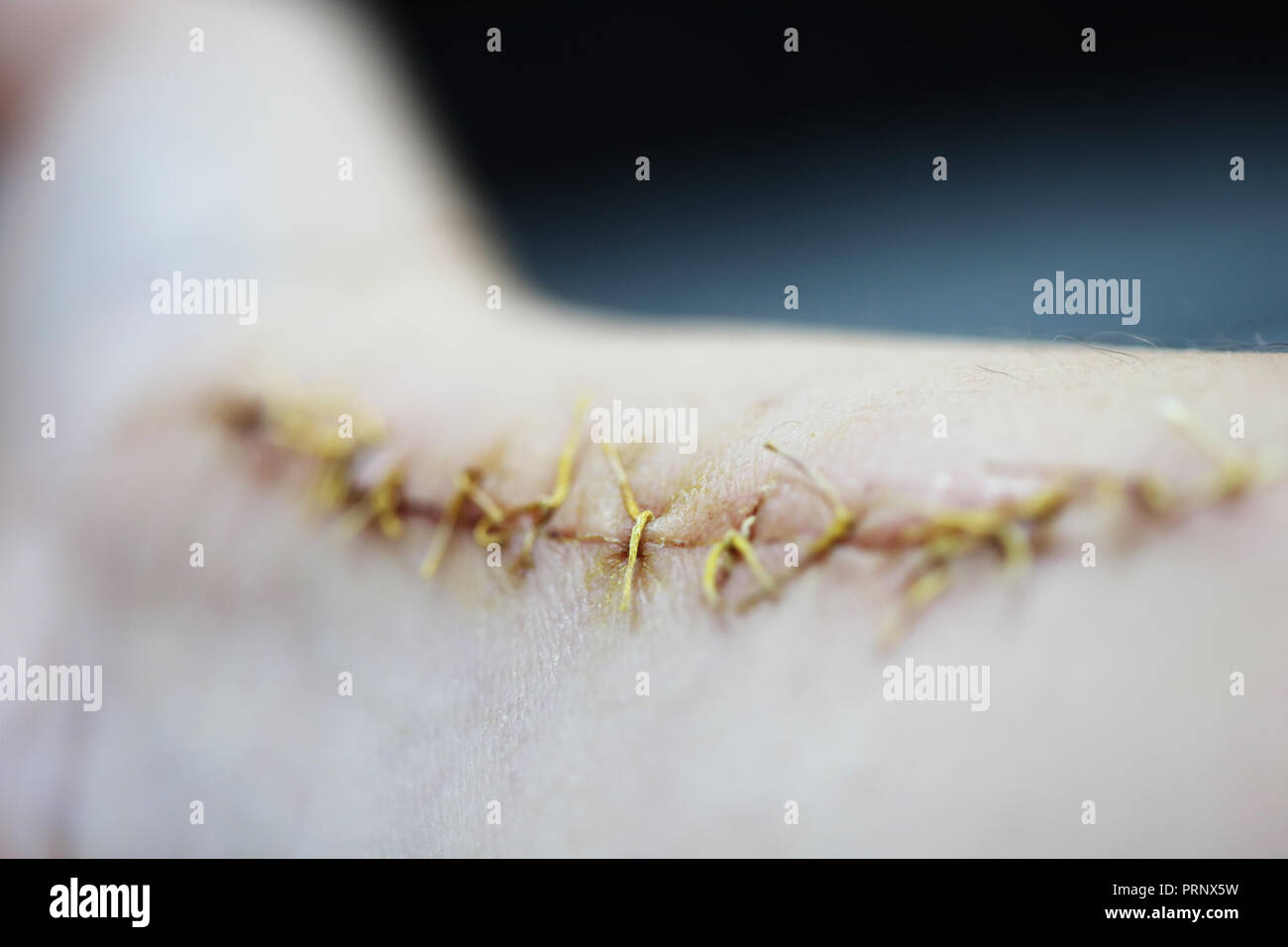 In prossimità di una mano humand male con una grossa cicatrice con un sacco di punti. Inquadratura orizzontale Foto Stock