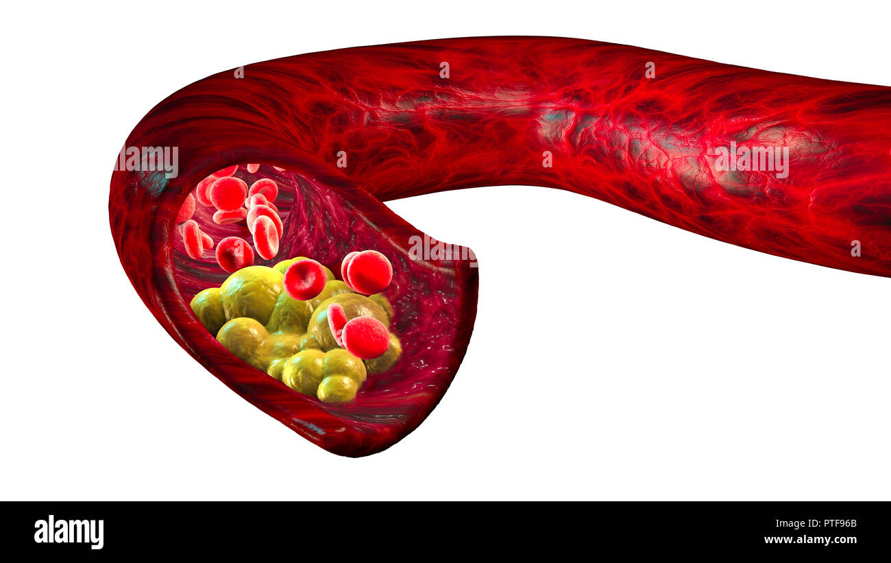 La formazione di colesterolo, grasso, arteria, una vena, un cuore. Le cellule rosse del sangue, il flusso di sangue. Restringimento di una vena per la formazione di grassi. Foto Stock