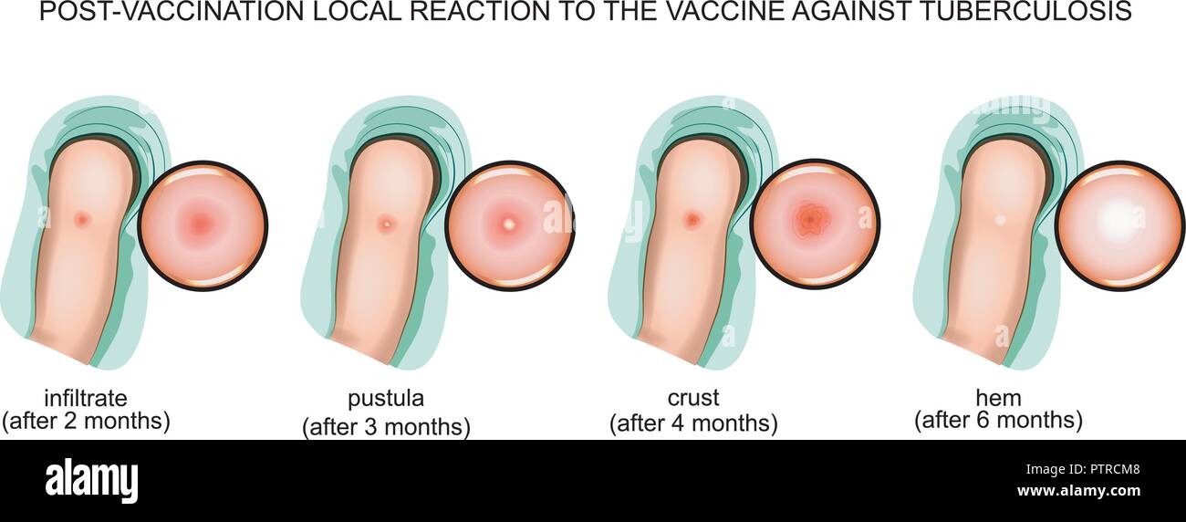 Illustrazione vettoriale di post-reazioni di vaccinazione per il vaccino contro la tubercolosi Illustrazione Vettoriale