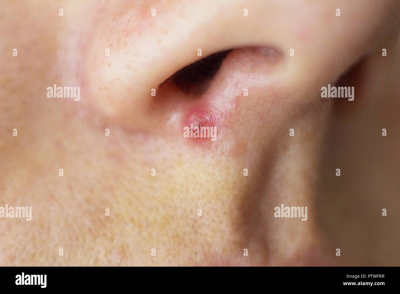 Brufolo sul naso immagini e fotografie stock ad alta risoluzione - Alamy