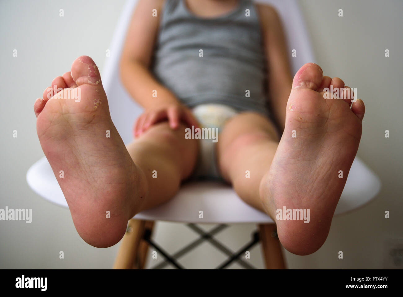 Le gambe del bambino con traballante pelle. Eczema, allergia, infezione da funghi Foto Stock