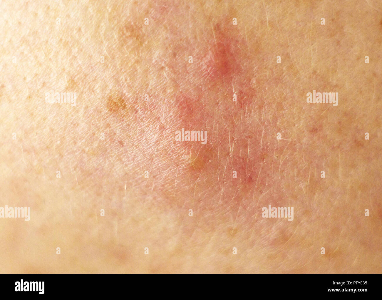 Arrossamento da acne sulla pelle, guanciale, macro, bianco-testa Foto Stock
