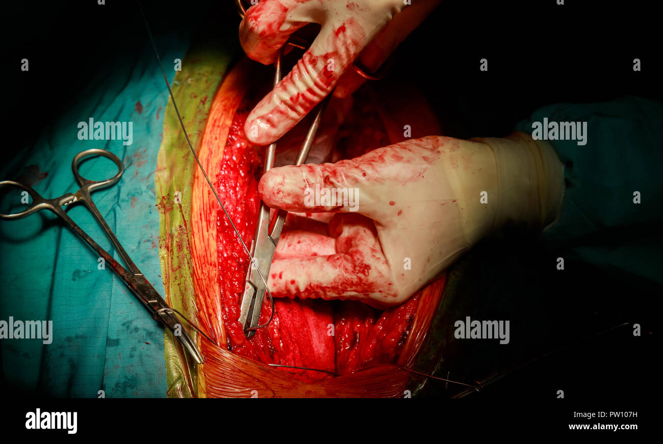 Tessuto di cucitura dopo un intervento di chirurgia cardiaca cucito su pelle dopo un'operazione Foto Stock