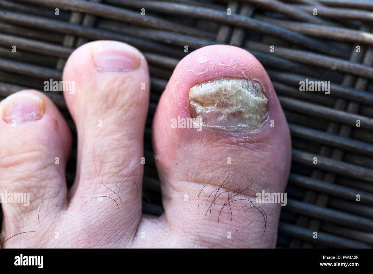Fungina infezione unghie sulla punta maschio. Foto Stock