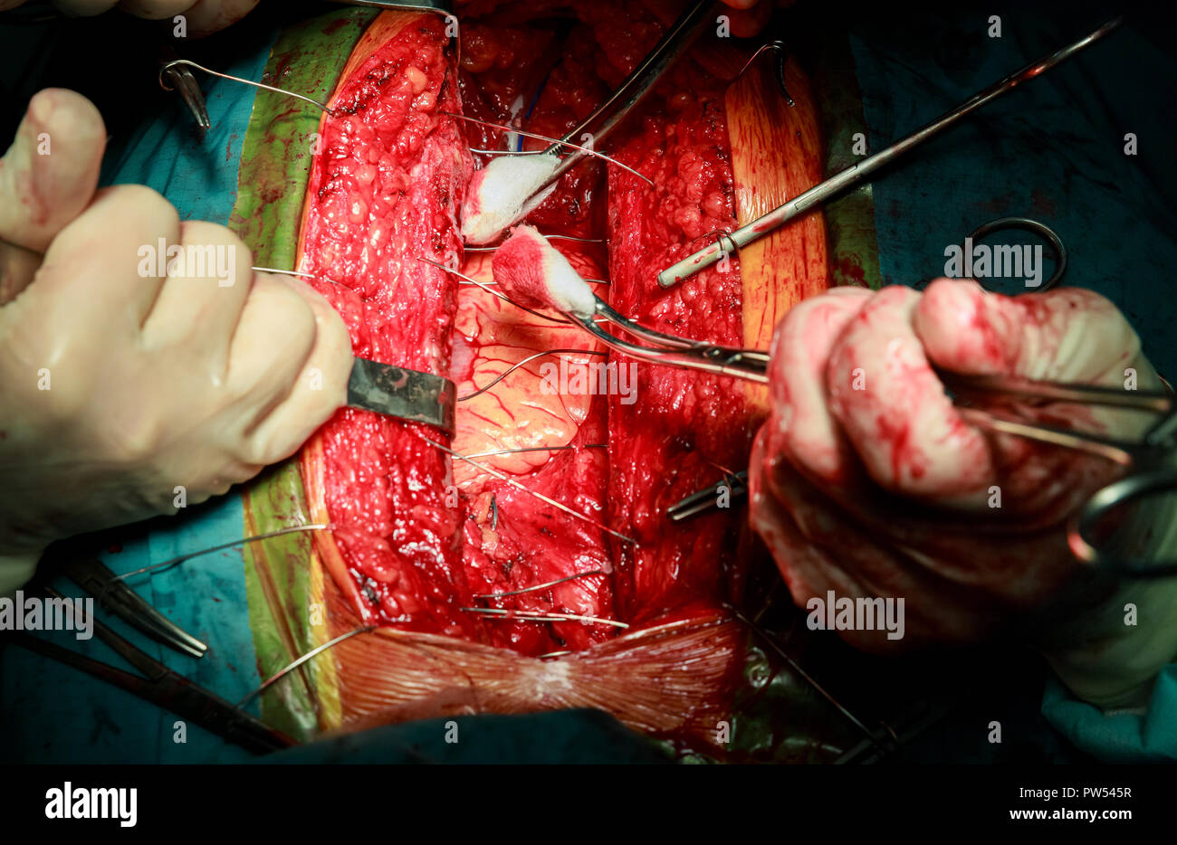 La chiusura di close-up torace dopo intervento chirurgico al cuore in un ospedale Foto Stock