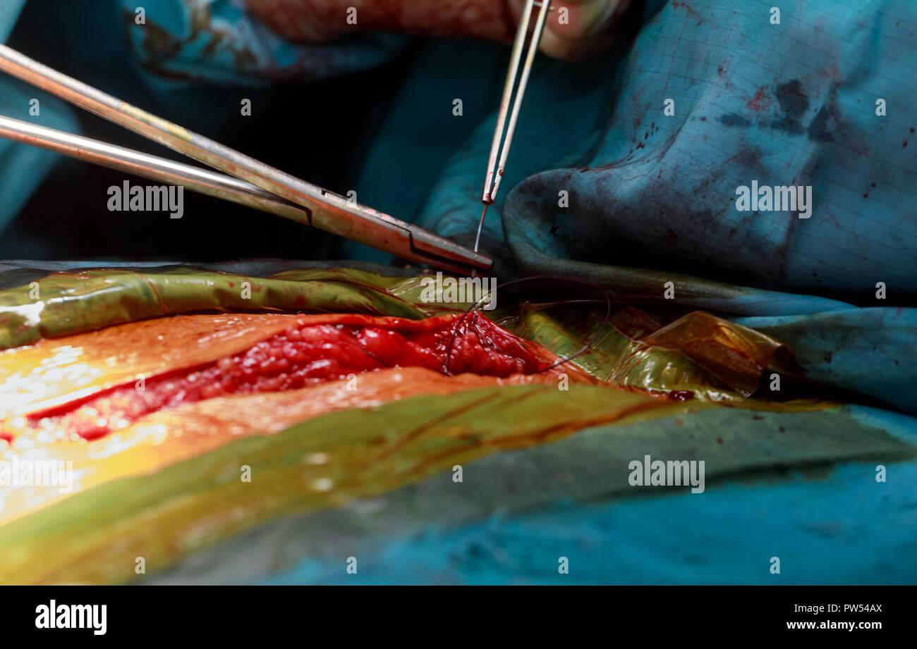 La sutura dopo la chirurgia con gli strumenti chirurgici e tessuti di close-up Foto Stock