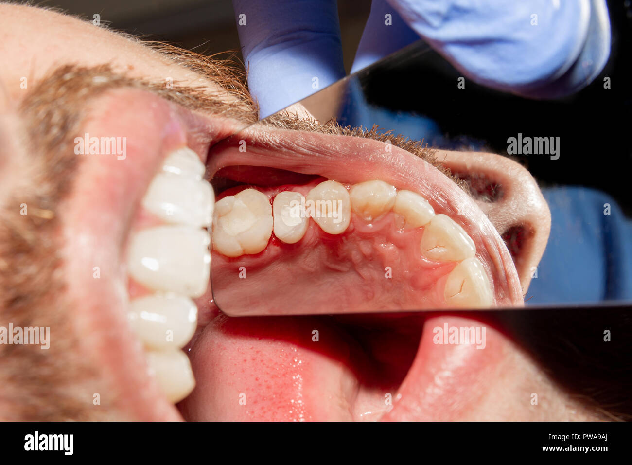 Close-up di un essere umano di marcio carie dentali presso lo stadio di trattamento in una clinica dentale. L'uso di gomma sistema dam con lattice sciarpe e clip di metallo, p Foto Stock