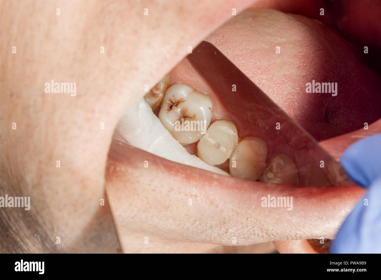 Close-up di un essere umano di marcio carie dentali presso lo stadio di trattamento in una clinica dentale. L'uso di gomma sistema dam con lattice sciarpe e clip di metallo, p Foto Stock