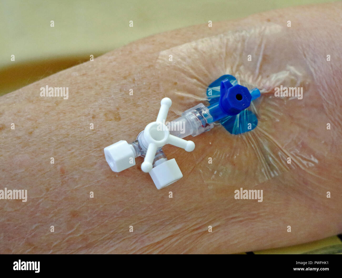 Una cannula inserita nel braccio di un paziente di prendere i campioni di sangue direttamente a intervalli frequenti. Foto Stock