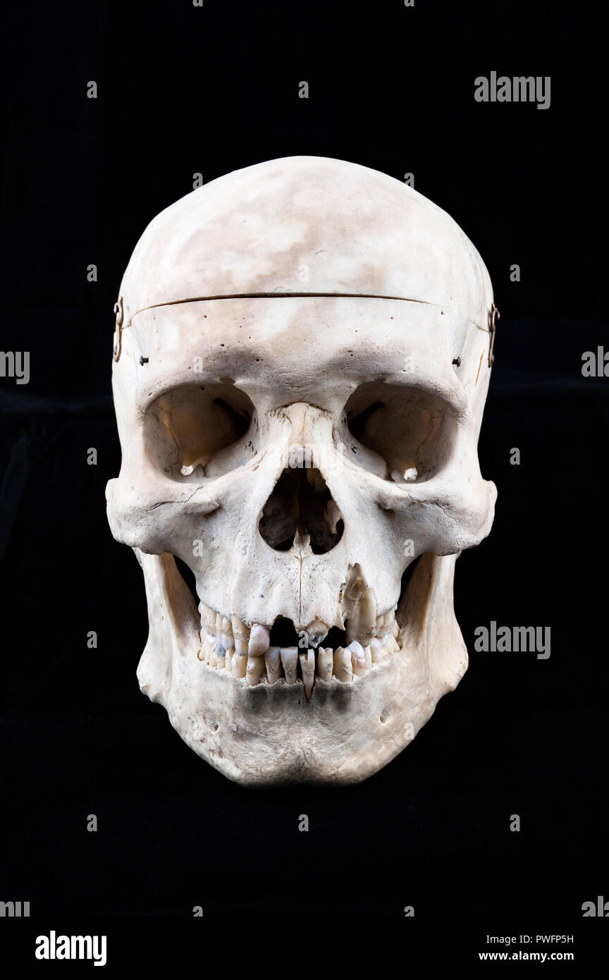 Cranio umano utilizzato per l'insegnamento di anatomia agli studenti di medicina, con parte superiore amovibile Foto Stock