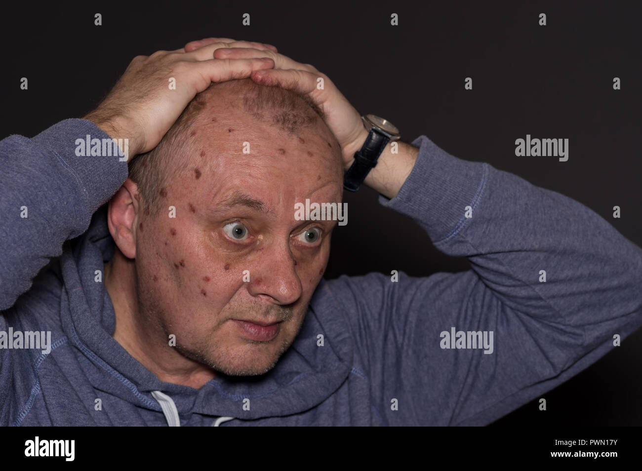 Ritratto di uomo maturo dopo azoto liquido di trattamento Foto Stock