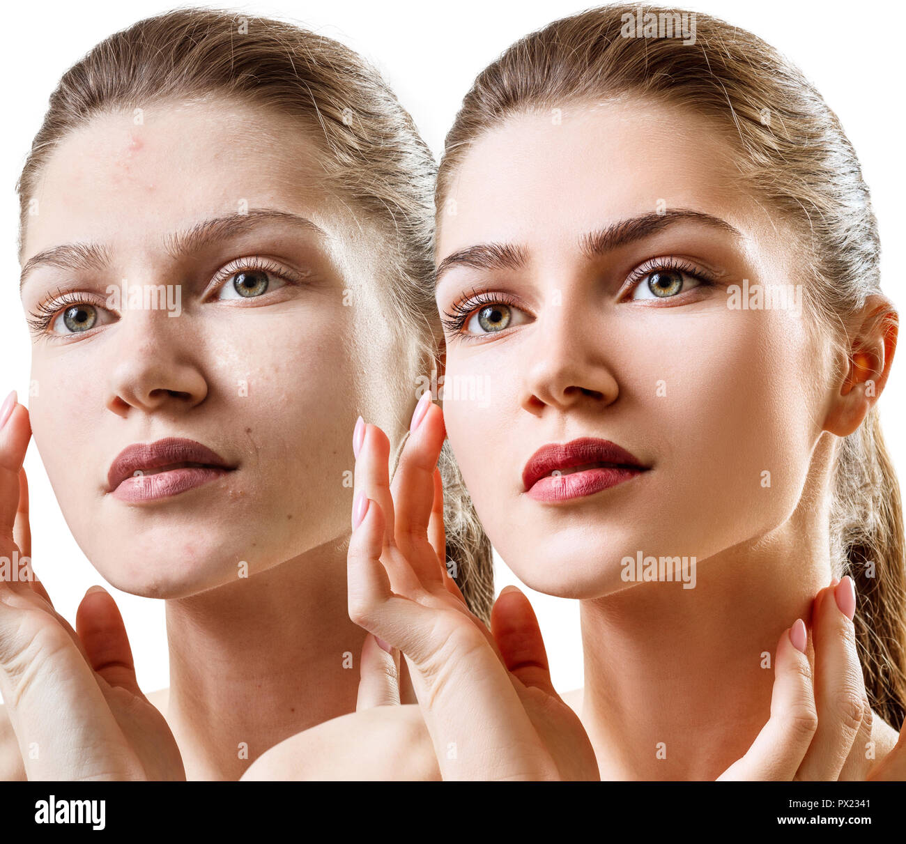Donna con acne prima e dopo il trattamento e make-up. Foto Stock